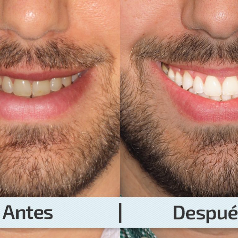 ortodoncia-barcelona-tipos-de-blanqueamiento-dental-2 (1)